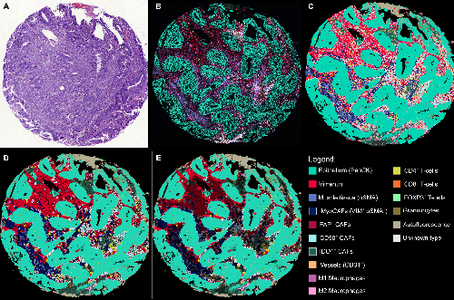 Fig. 1: Tissue profiling approach: (A) H&E-stained example core (sequential cut), (B) seqIFTM-stained example cores (31-plex), (C) Pixie tissue classification results, (D) Tissue classification after voronoi-tesselation of the stromal compartment, (E) Extraction of stromal areas that are directly interacting with the epithelium (highlighted)